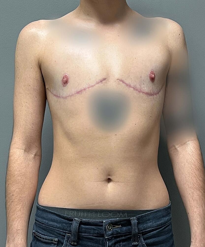 Ftm Top Surgery Before & After