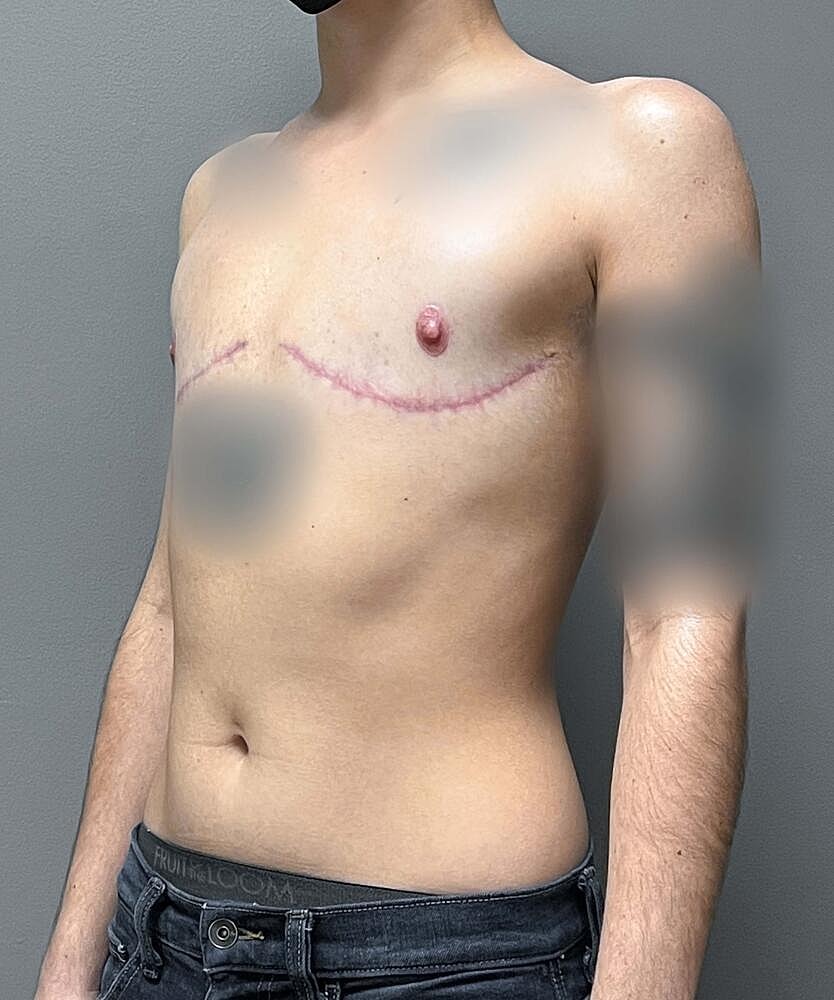 Ftm Top Surgery Before & After