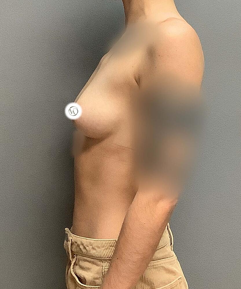 Ftm Top Surgery Before & After