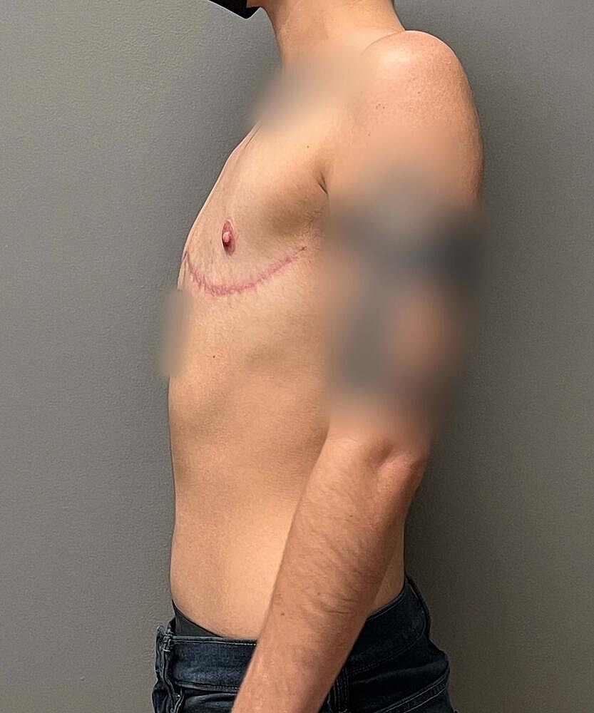 Ftm Top Surgery Before & After