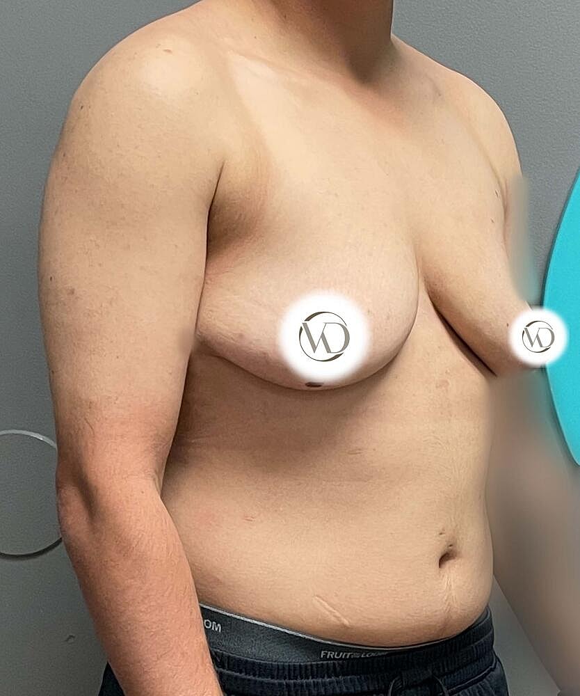 Ftm Top Surgery Before & After