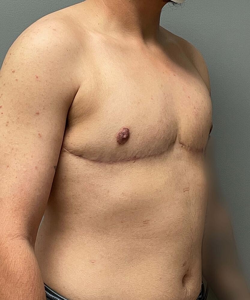 Ftm Top Surgery Before & After