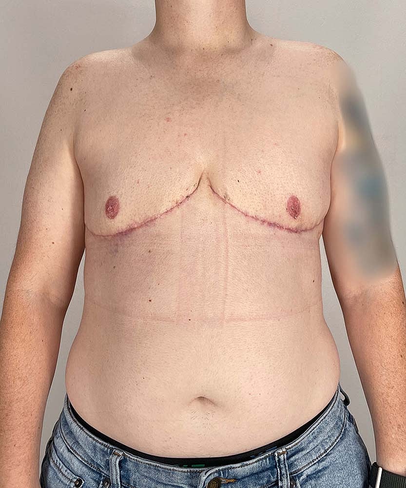 Ftm Top Surgery Before & After