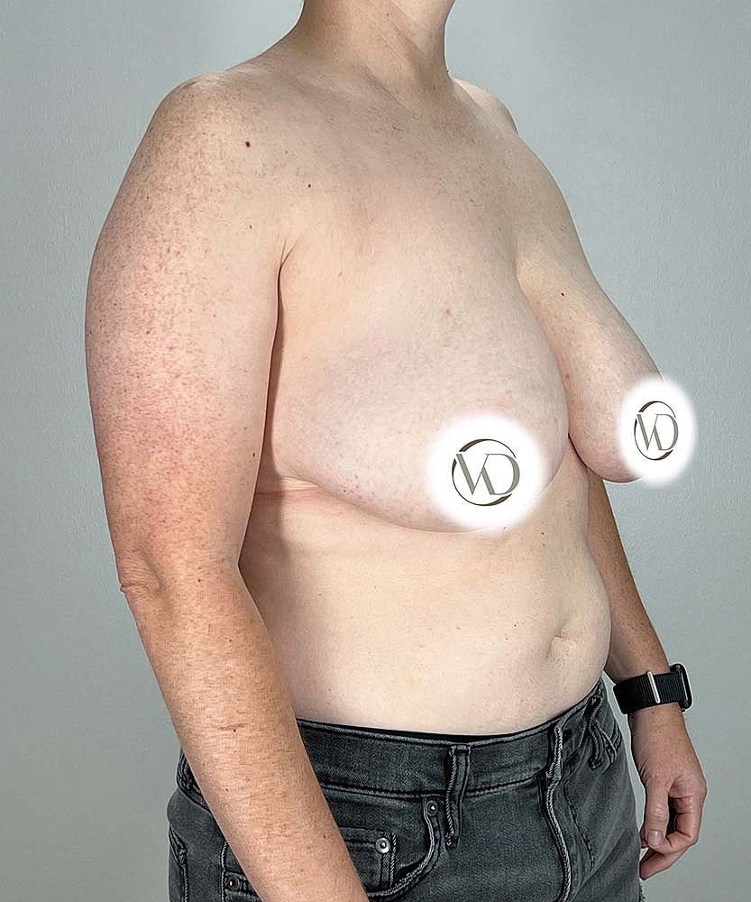 Ftm Top Surgery Before & After