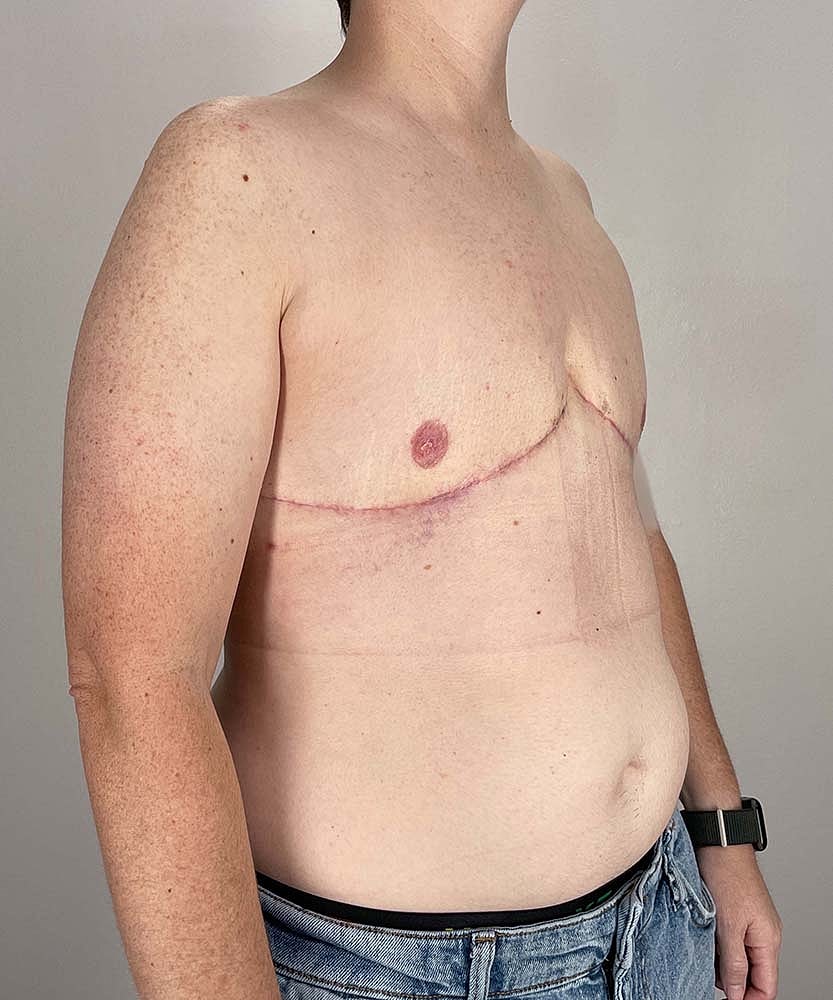 Ftm Top Surgery Before & After
