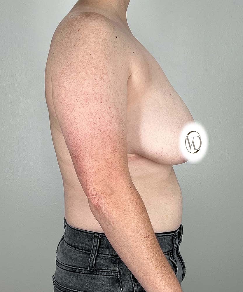 Ftm Top Surgery Before & After
