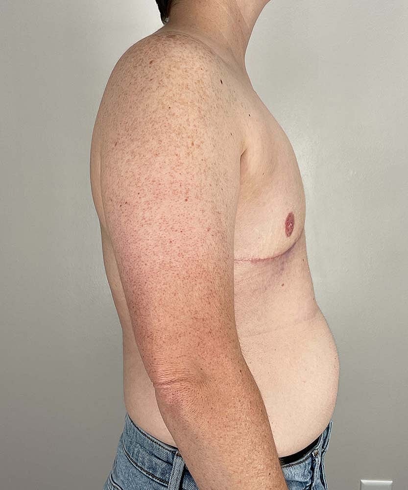 Ftm Top Surgery Before & After
