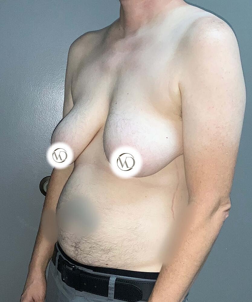 Ftm Top Surgery Before & After