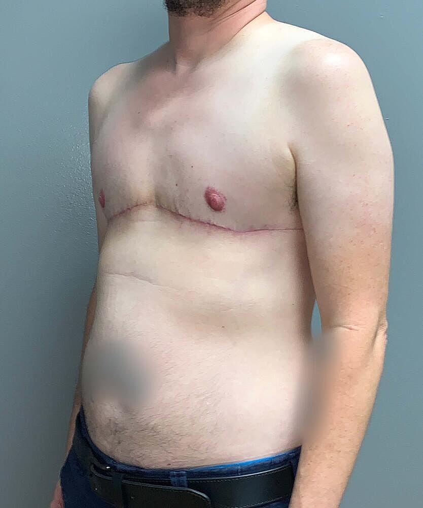 Ftm Top Surgery Before & After