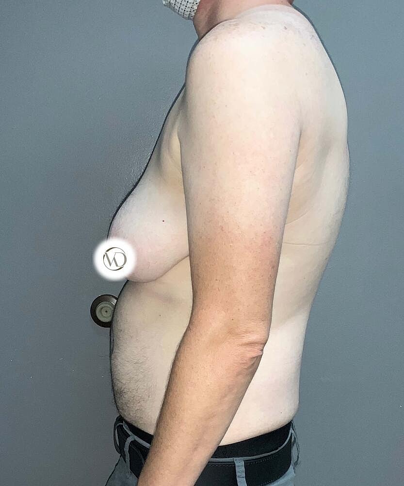 Ftm Top Surgery Before & After