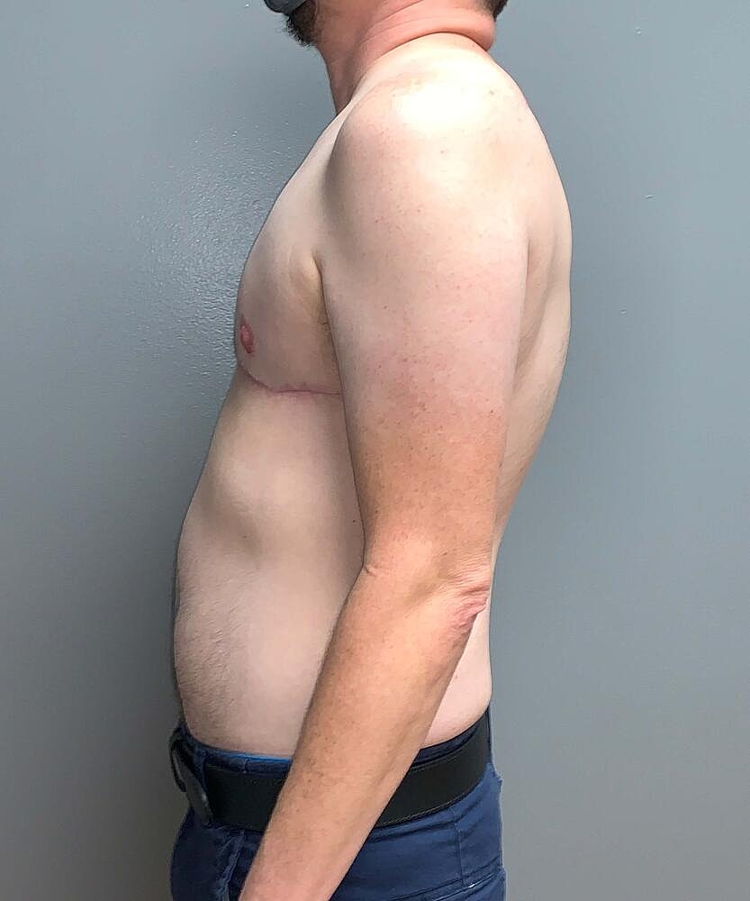 Ftm Top Surgery Before & After