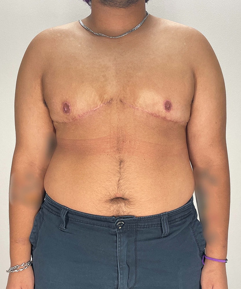Ftm Top Surgery Before & After