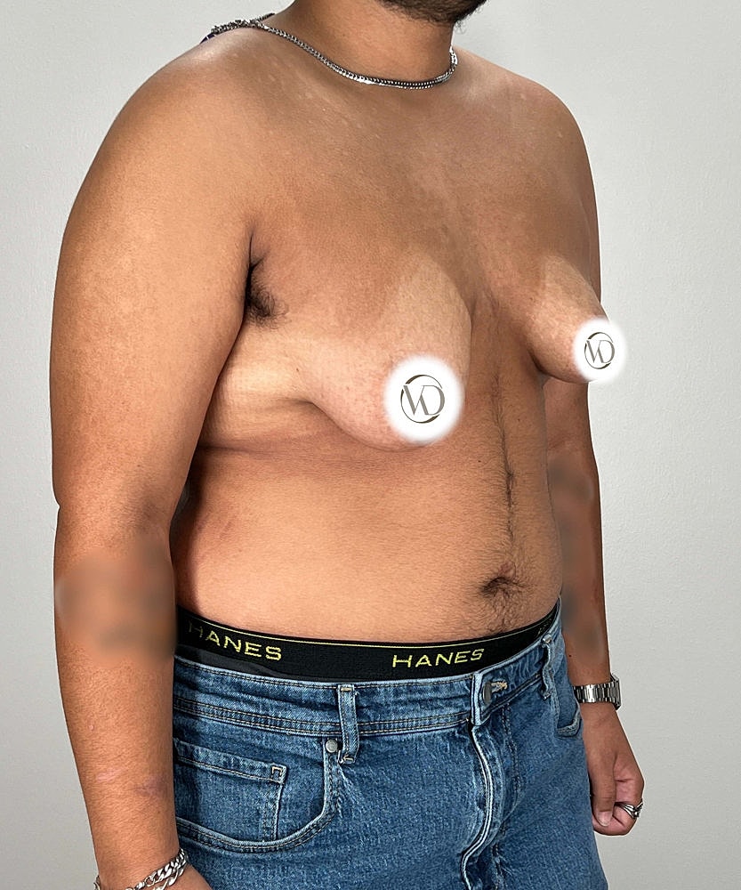 Ftm Top Surgery Before & After