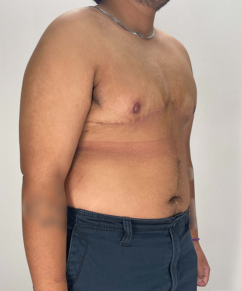 Ftm Top Surgery Before & After