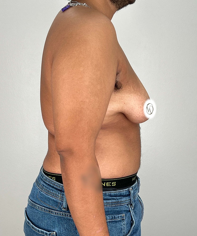 Ftm Top Surgery Before & After