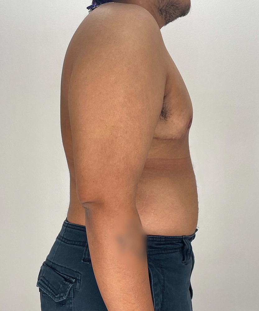 Ftm Top Surgery Before & After