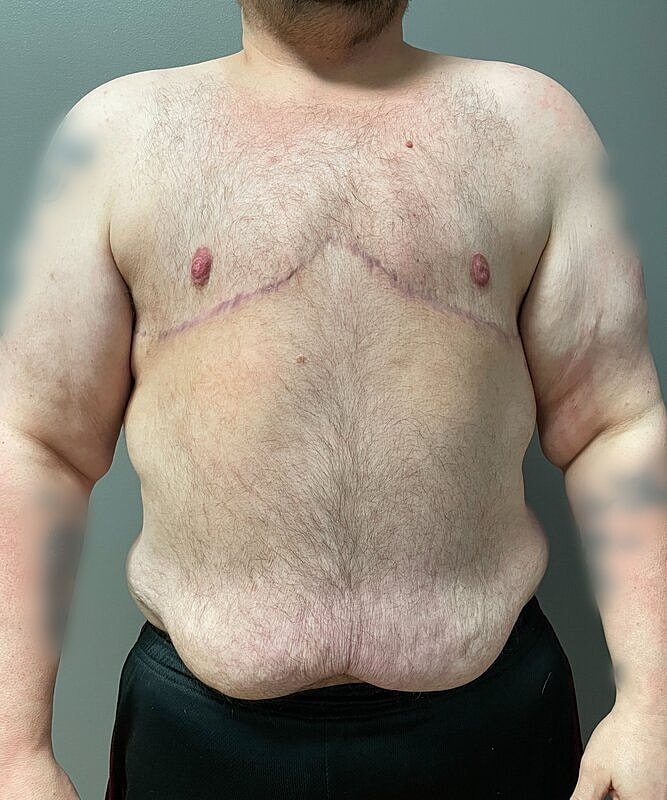 Ftm Top Surgery Before & After