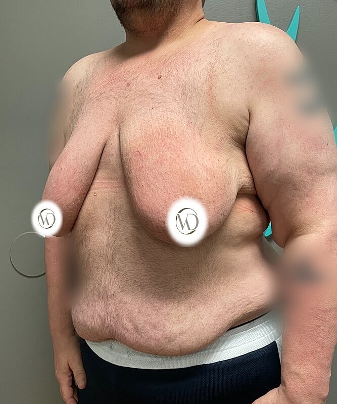 Ftm Top Surgery Before & After