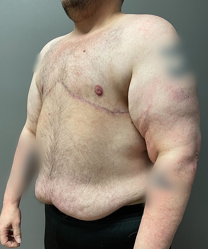 Ftm Top Surgery Before & After
