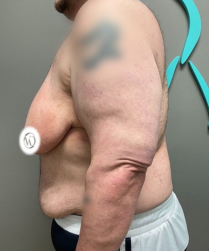 Ftm Top Surgery Before & After