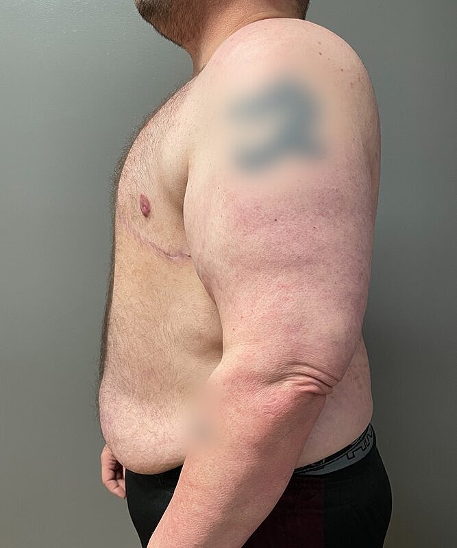 Ftm Top Surgery Before & After