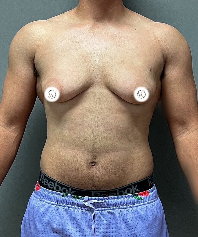Ftm Top Surgery Before & After