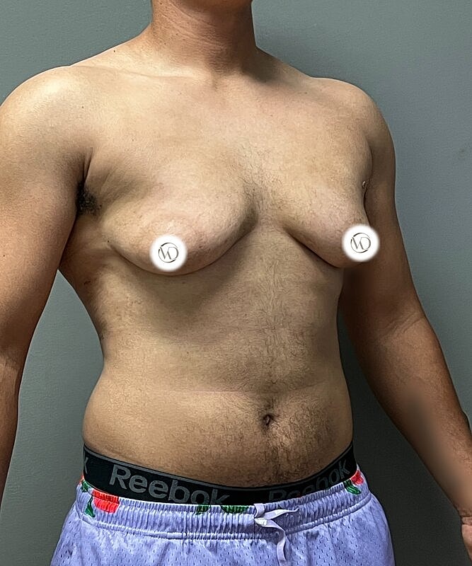 Ftm Top Surgery Before & After
