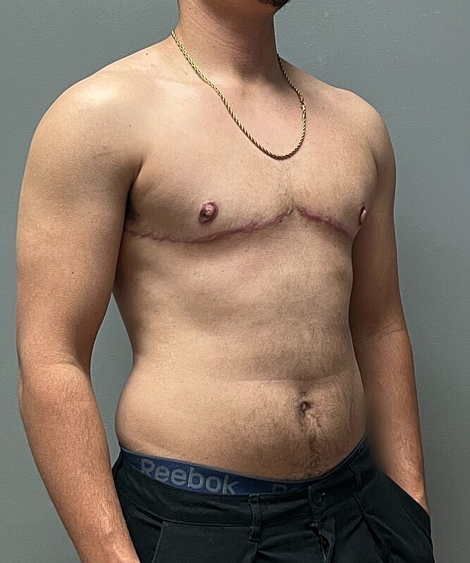 Ftm Top Surgery Before & After
