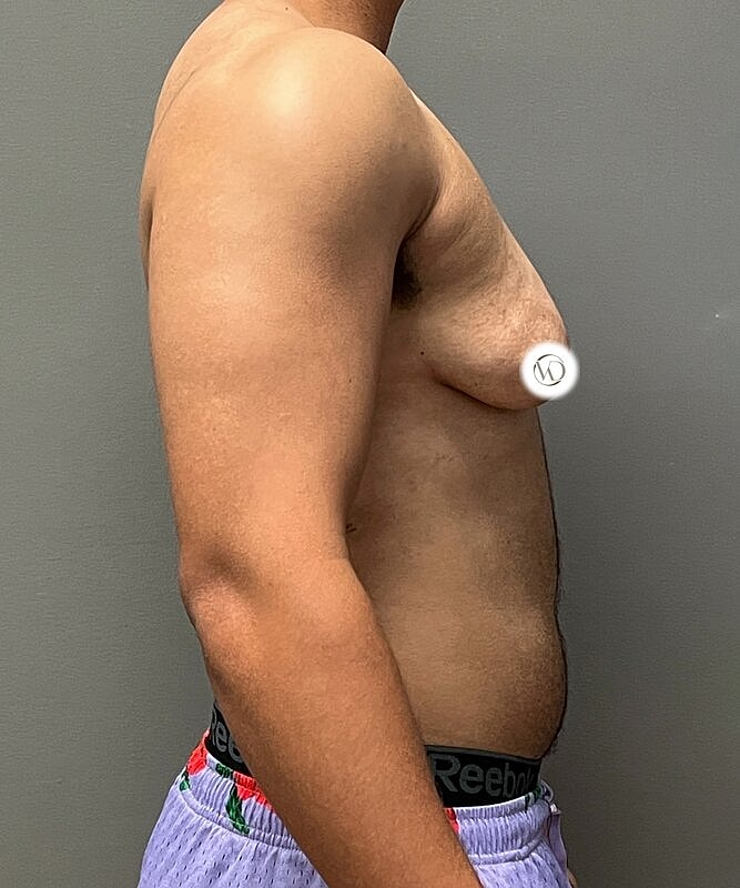 Ftm Top Surgery Before & After