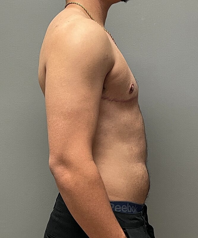 Ftm Top Surgery Before & After