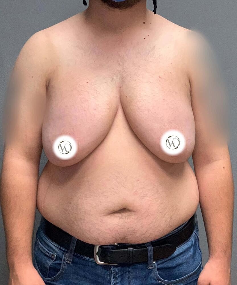 Ftm Top Surgery Before & After