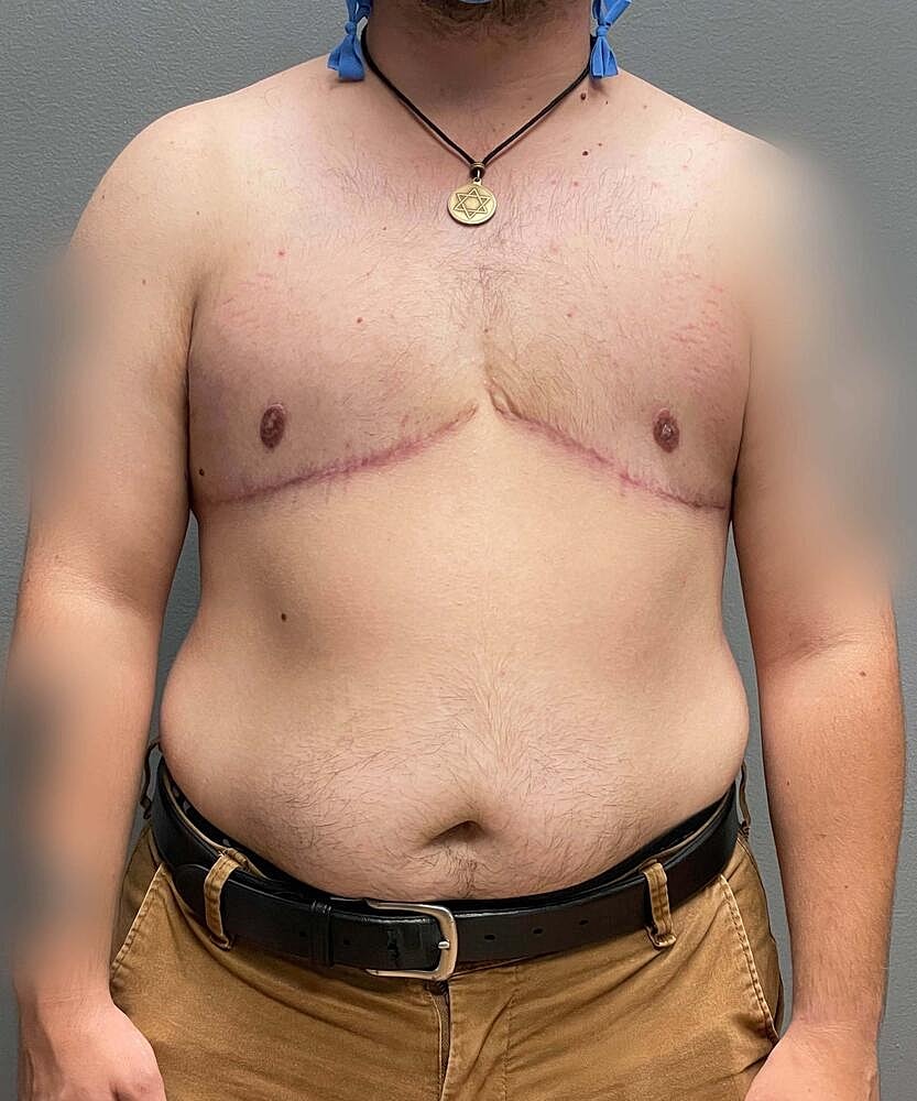 Ftm Top Surgery Before & After