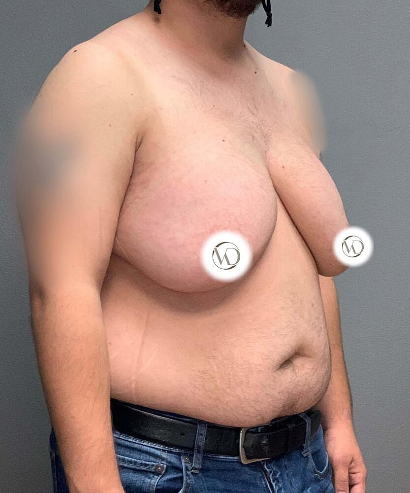 Ftm Top Surgery Before & After