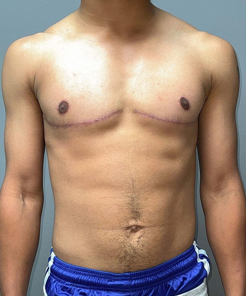 Ftm Top Surgery Before & After