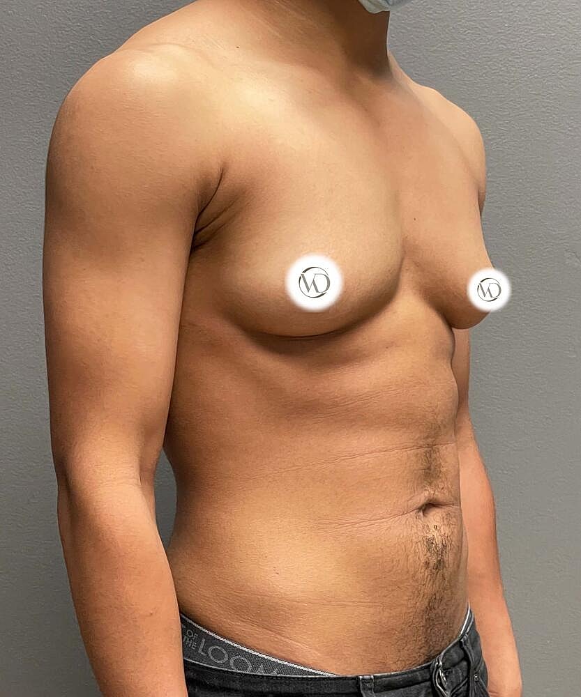Ftm Top Surgery Before & After