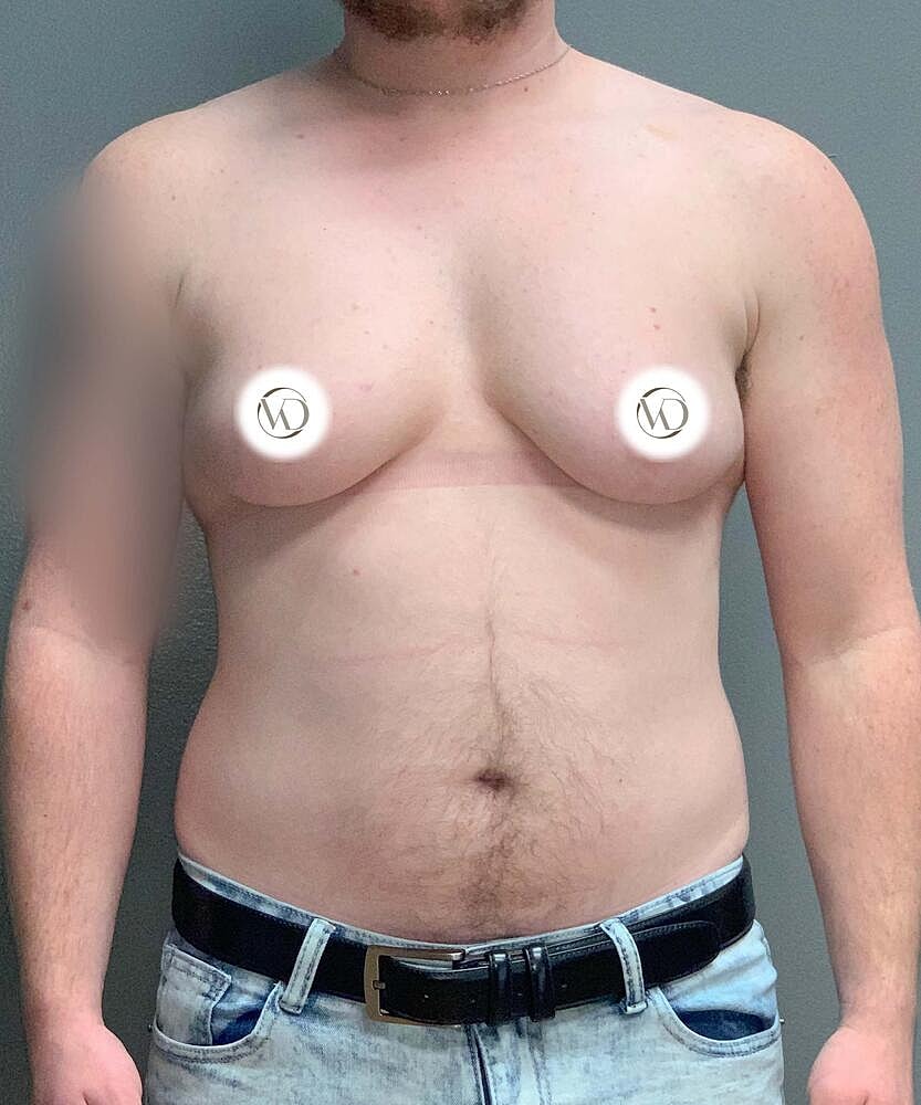 Ftm Top Surgery Before & After