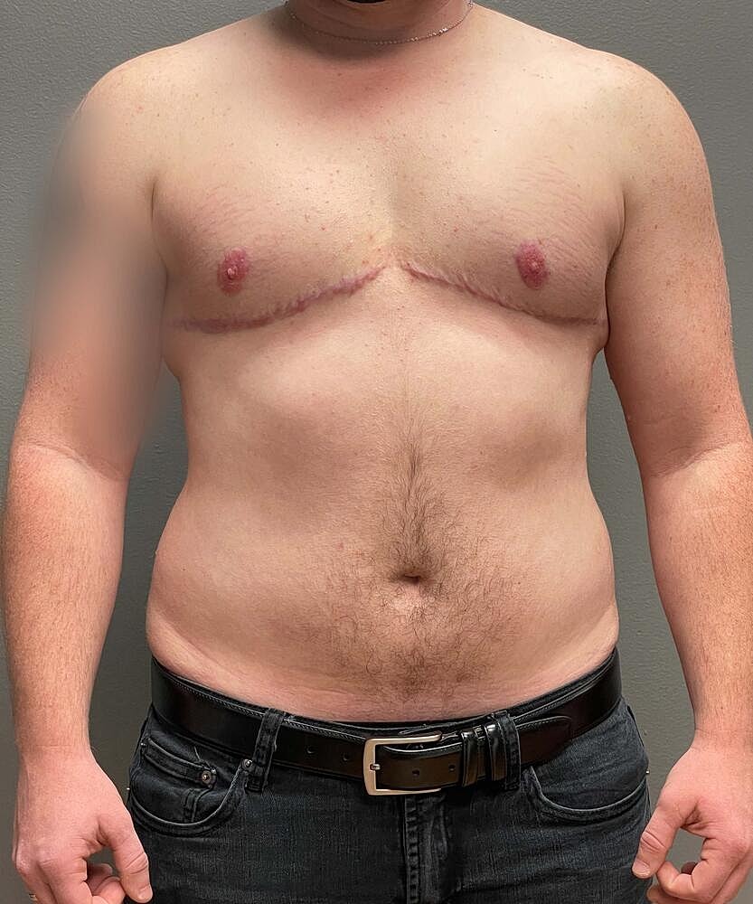 Ftm Top Surgery Before & After