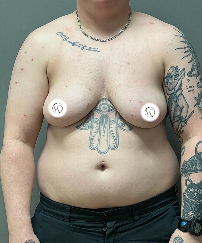 Ftm Top Surgery Before & After