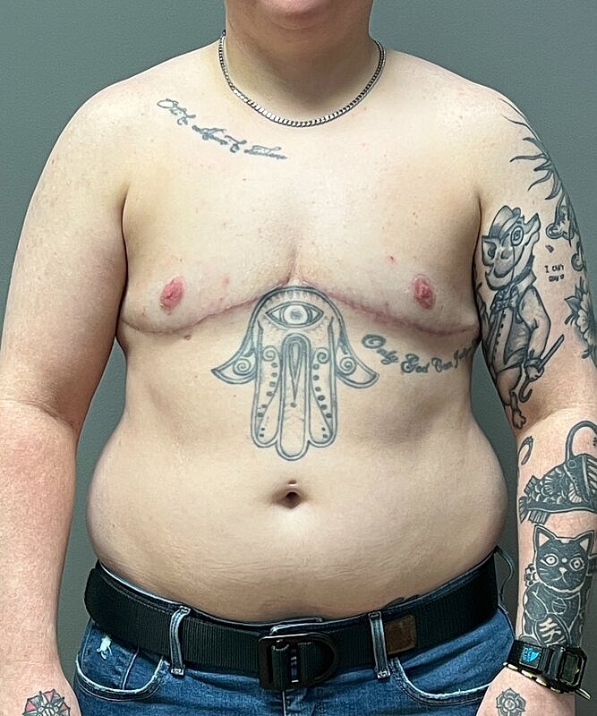 Ftm Top Surgery Before & After