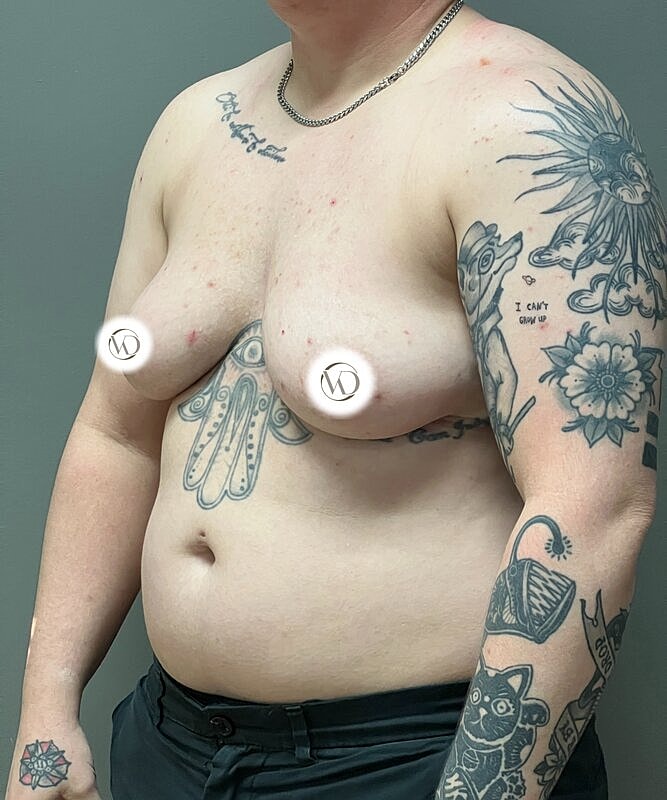 Ftm Top Surgery Before & After