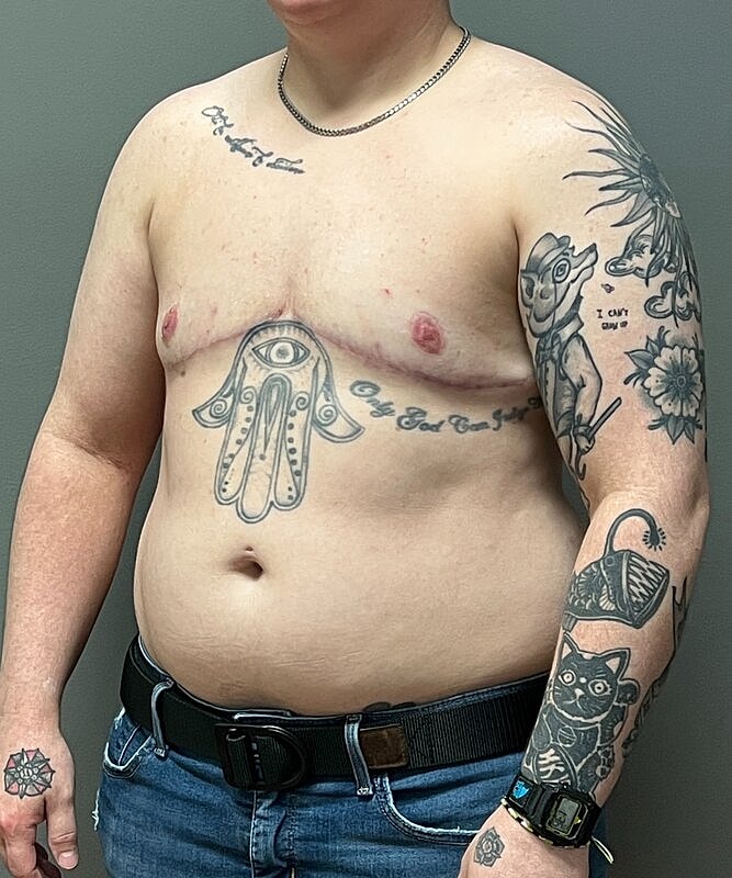 Ftm Top Surgery Before & After
