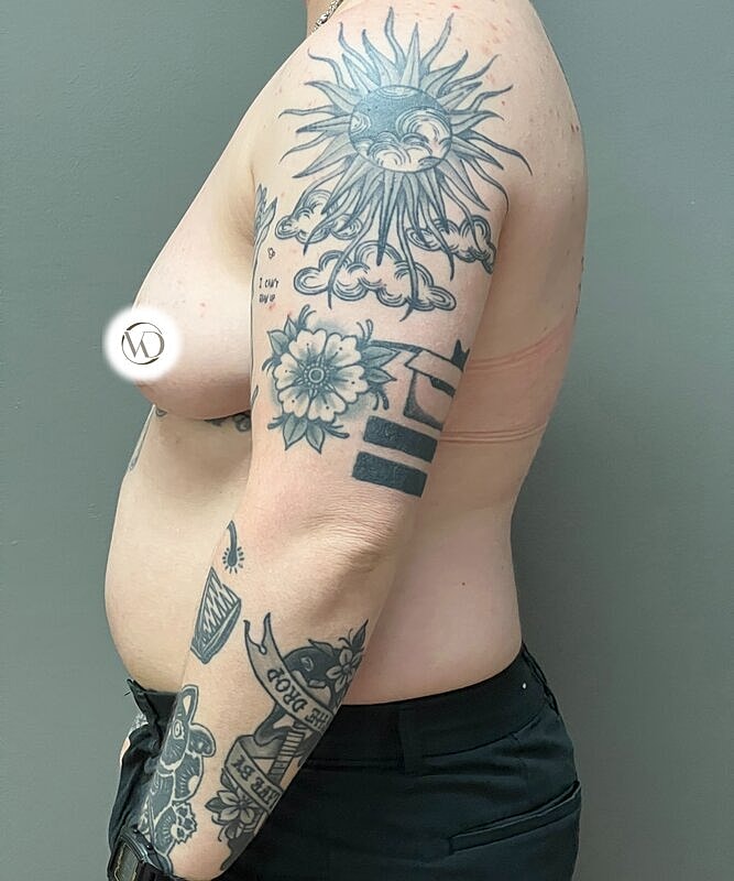 Ftm Top Surgery Before & After