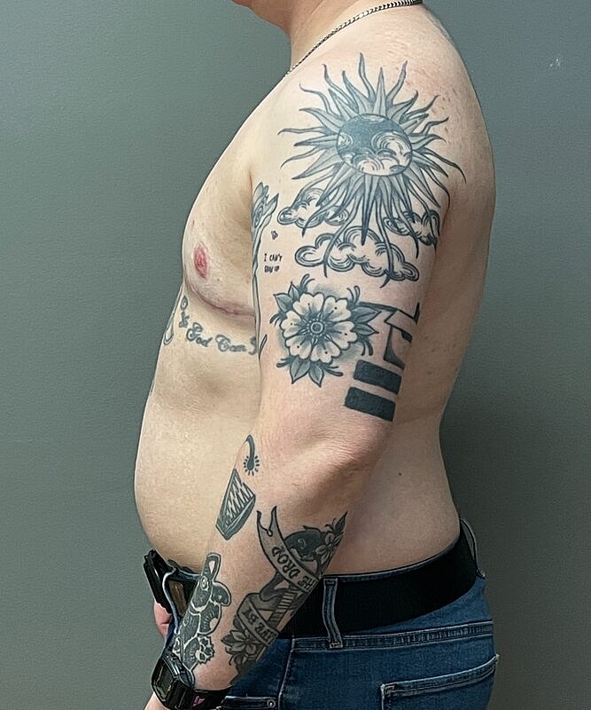 Ftm Top Surgery Before & After