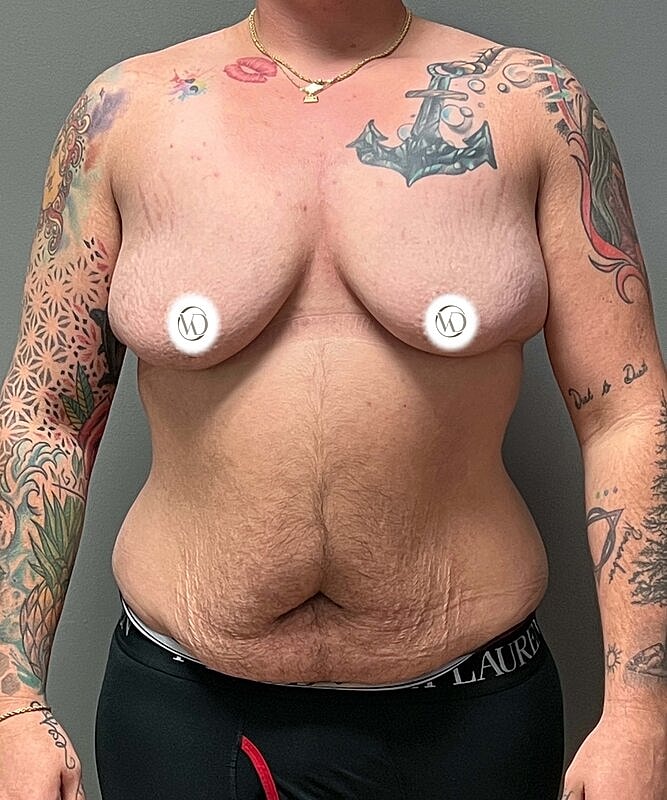Ftm Top Surgery Before & After