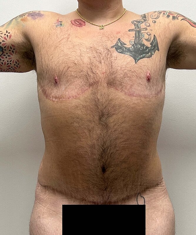 Ftm Top Surgery Before & After