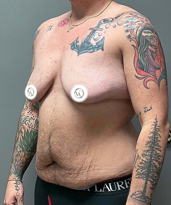 Ftm Top Surgery Before & After