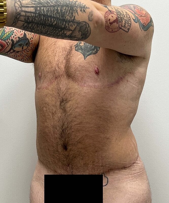 Ftm Top Surgery Before & After