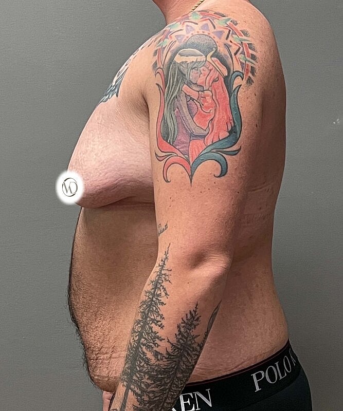 Ftm Top Surgery Before & After