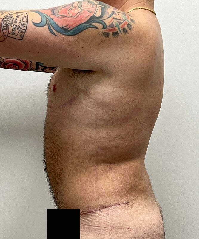Ftm Top Surgery Before & After
