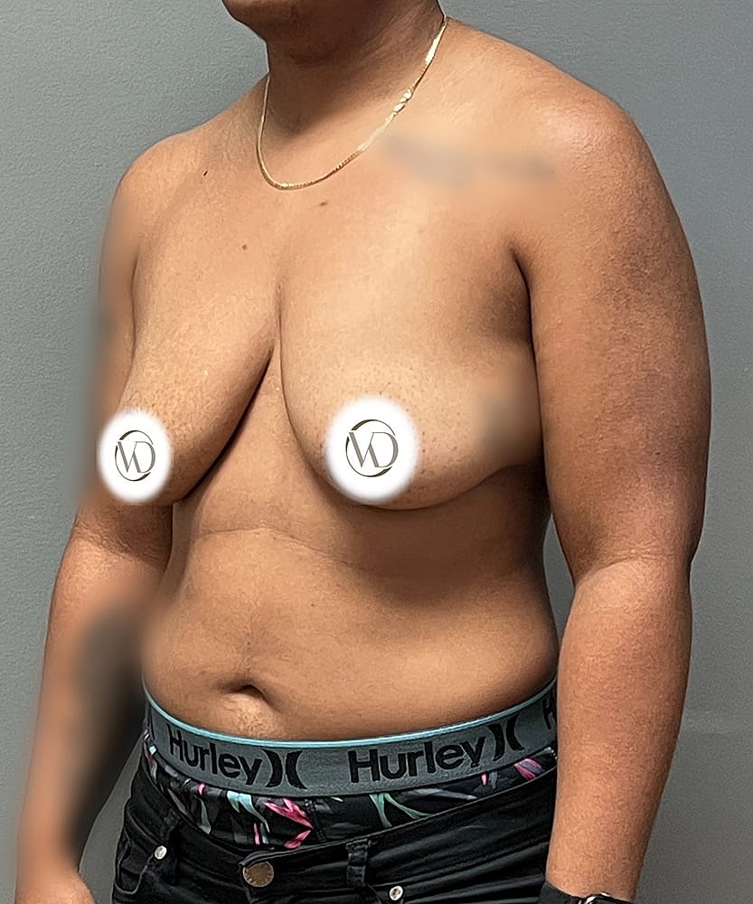 Ftm Top Surgery Before & After